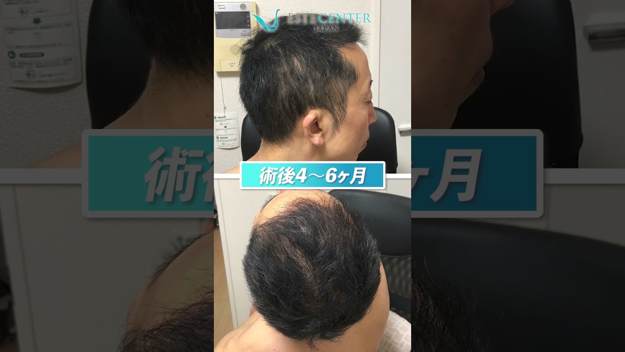 トルコ自毛植毛・海外医療ツーリズム エステセンタージャパン | トルコ