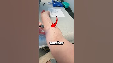 How An Allergy Test Works Explained (📸: only4hyunjinnnie)