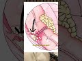 Doctor Explains One DEADLY Complication Of Bowel Surgery