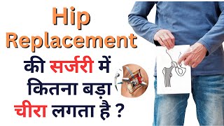 Hip Replacement सर्जरी में कितना बड़ा चीरा लगता है #hippain #hipreplacementsurgeoningurgaon