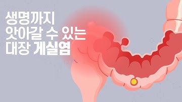 생명까지 앗아갈 수 있는 대장 게실염, 아랫배 통증 주의해야 [건강프라임]