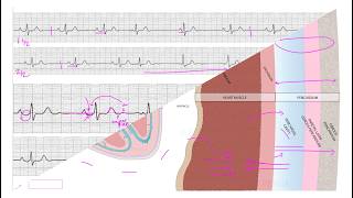 PERICARDITIS and/or ATRIAL INFARCTION (advanced ECG interpretation)