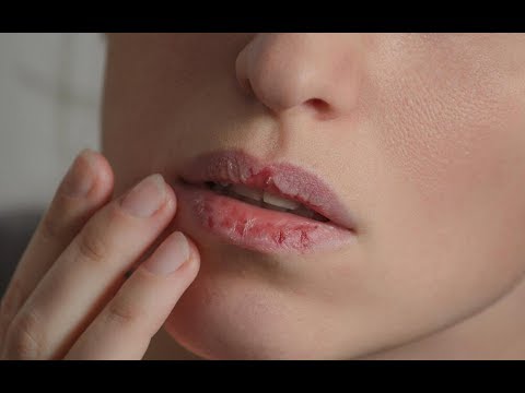 Curar Labios Quemados. Consejos Prácticos