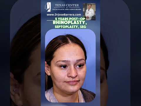 Video thumbnail: 5-year post-operative results following Rhinoplasty, Septoplasty, and Septal Extension Graft (SEG). · Dr. Jose Barrera