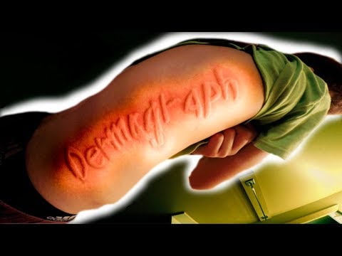 RARE SKIN DISORDER! YOU CAN DRAW PICTURES ON HIS SKIN!