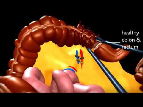Video: La sigmoidectomia è uguale alla colectomia sigmoidea?