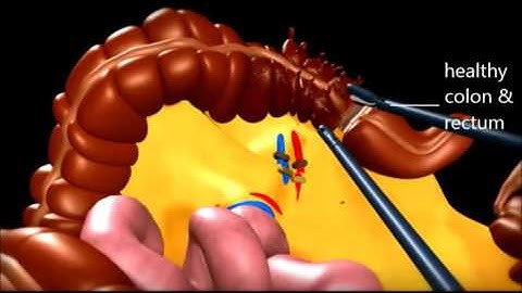 Laparoscopic Surgery for Diverticulitis - English