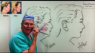 SMAS vs Deep Plane Facelift: What You Need to Know | Philadelphia Facelift Surgeon Dr. Claytor