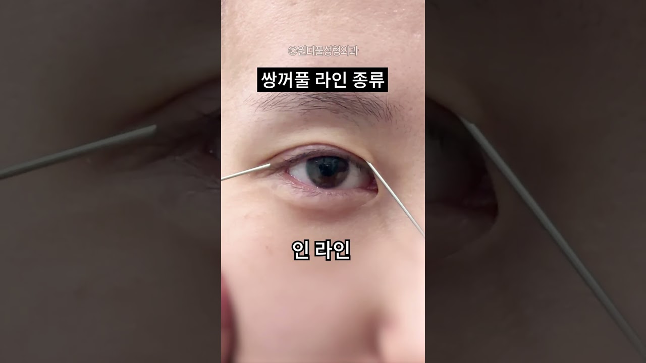 Гайхамшигтай Гоо сайхны мэс заслын эмнэлэг - Давхраа зовхины шугамын төрлүүд