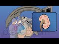 Kidney Stones Surgery - PreOp® Patient Education & Patient Engagement