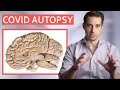 18 COVID Autopsies (This is what they found in the Brain)