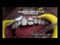 Diastema Closure