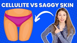 CELLULITE VS SAGGY SKIN ON THIGHS 🤔 DERMATOLOGIST @DrDrayzday