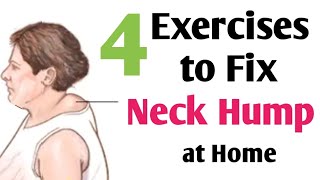 Neck Hump exercises at home | Buffalo Hump | Dowager's Hump | Hindi