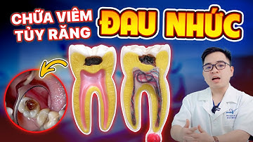 Viêm Tủy Răng: Chỉ Với 2 Cách Chữa Viêm Tủy Răng Triệt Để!