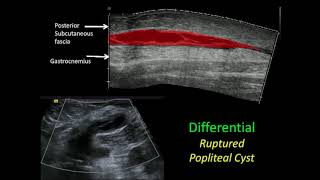 Ultrasound of the Lower Extremity: Muscle Pathology