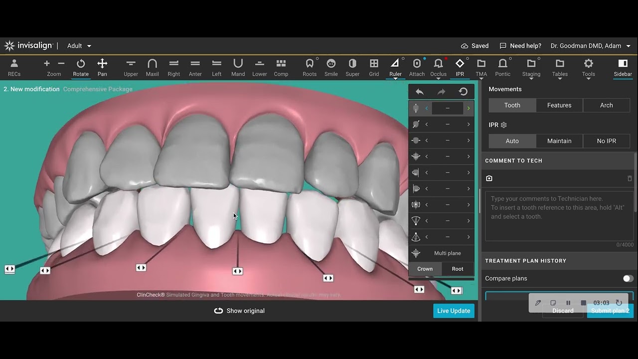 ADVANCED INVISALIGN CONCEPT- RESOLVING LOWER CROWDING AND THE EFFECT ON OVERJET REDUCTION AND COS