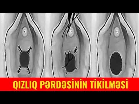 Qızlıq Pərdəsi Pozulub – Bərpası Mümkündür?