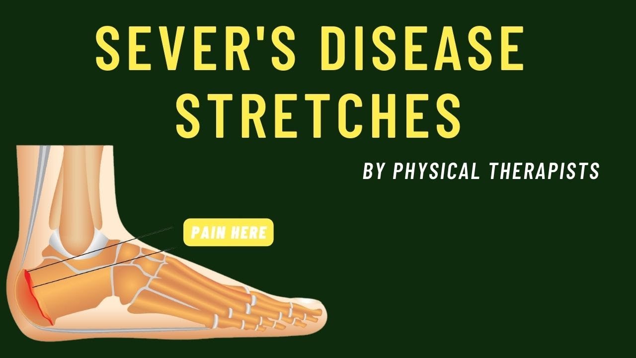 Sever's Disease STRETCHES to ease your pain! YouTube