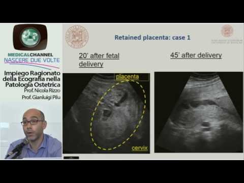Video: 3 modi per riconoscere i segni di un'emorragia post-partum