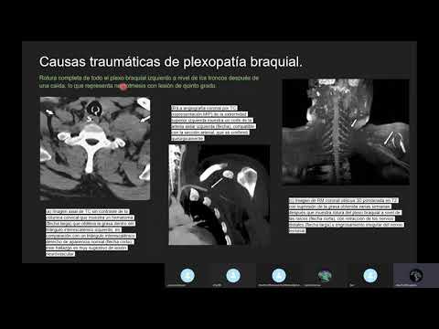 Video: ¿La resonancia magnética mostrará lesión del plexo braquial?