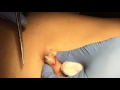 Cheesy Cyst Excision