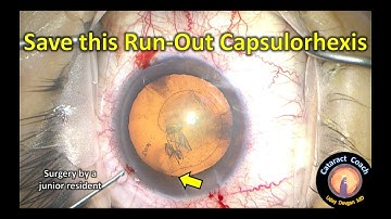 How to Save this Run-Out Capsulorhexis in Cataract Surgery