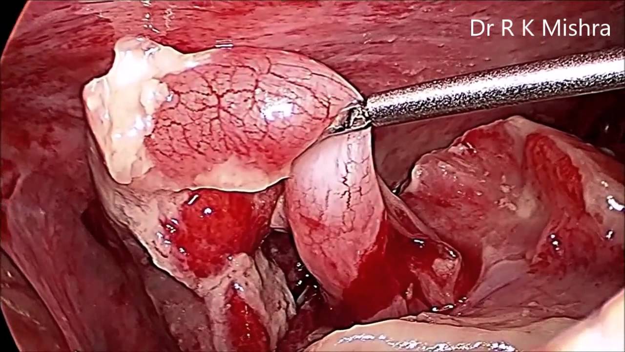 Laparoscopic Management Of Rupture Pediatric Appendix In Pediatric