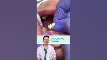 Cầu răng sứ bị hỏng | Bác sĩ Cường #bacsicuong #shorts