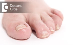 Causes of brittle toenails and its management  Dr. Rasya Dixit