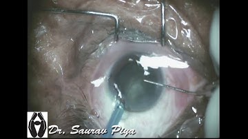 CONQUERING SOFT CATARACT - Dr. Saurav Piya