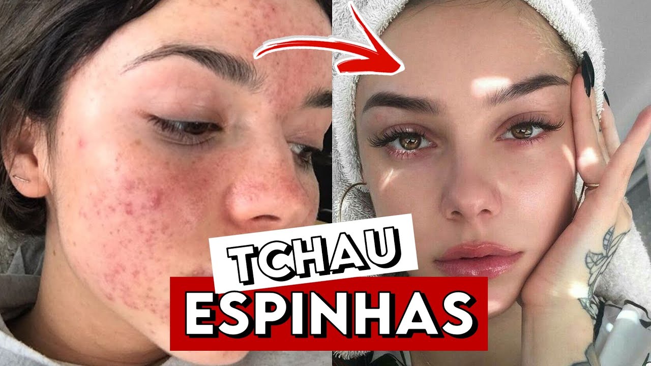 COMO ACABAR com as ESPINHAS RÁPIDO | Dicas para ELIMINAR a ACNE ...