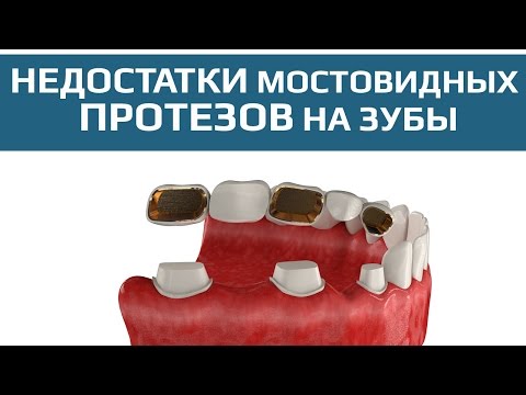 Недостатки мостовидных протезов. Атрофия костной ткани и обточка соседних зубов