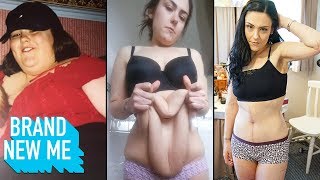 I Lost 140lbs And Finally Had My Extreme Excess Skin Removed | BRAND NEW ME