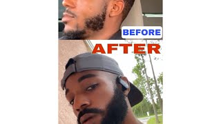 TIPS TO GROW A BEARD // Cover Patches (Minoxidil)