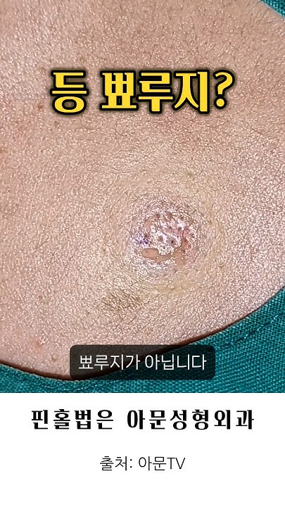 등 뾰루지 압출 제거 (핀홀법 주머니 피지낭종 표피낭종 수술 피부과 성형외과 병원 Epidermal Cyst Surgery ...
