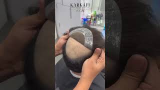 صالة عرض قرقفي للشعرمخصصة للرجال / الشعر طبيعي / استبدال الشعر من دون جراحة / Hair Fixing For Men