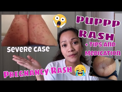 PUPPP RASH DURING PREGNANCY😭 | TIPS TO LESSEN ITCHINESS + MEDICATION | BEFORE & AFTER SKIN CONDITION