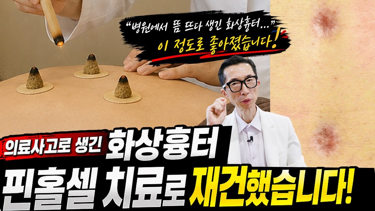 한의원에서 뜸 뜨다 생긴 화상흉터! 이것도 핀홀셀로 깨끗히 치료했습니다!