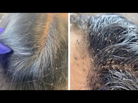 Hair Clinic Remove Hundreds Of Lice From Client's Head
