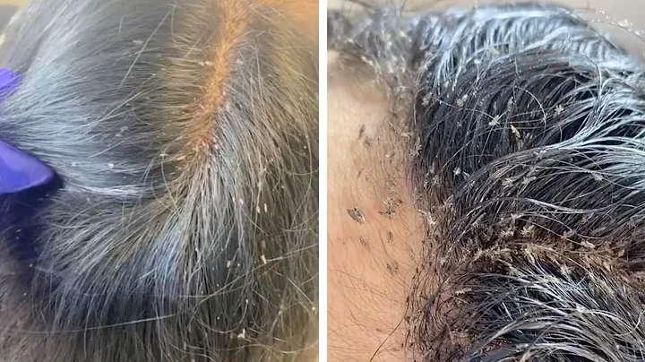 Hair Clinic Remove Hundreds Of Lice From Client's Head