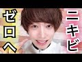 【驚きの効果】１週間でニキビを治す＆できなくする方法【40個→0個】〜毎日メイク/スキンケア〜