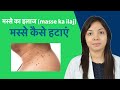 मस्से का इलाज/masse ka ilaj | मस्से Warts या Skin Tags को जड़ से हटाने के उपाय | Warts ka ilaj Hindi