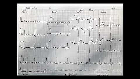 ECG 41 Hội chứng Brugada và sóng U