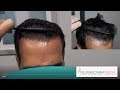 Repair of FUT and FUE Hair Transplant | 1,935 Grafts | Feller & Bloxham, NY, NYC, Long Island