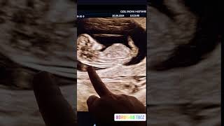 Gebelikte Fetal Ense Kalinliği Ni Dogru Olcmek. Zeka Testleri. Dr. Mehmet Boz