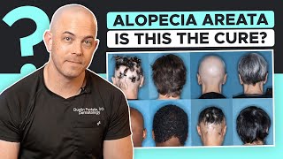 New Drug Olumiant (Baracitinib) Approved for Alopecia Areata