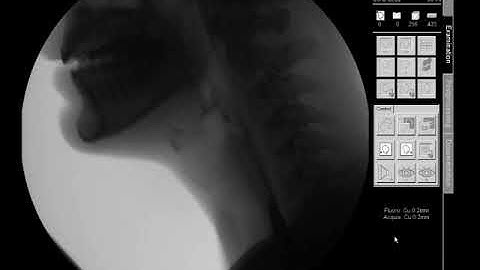 Puréed Texture/Applesauce - Modified Barium Swallow Study (MBSS) Lateral View HD