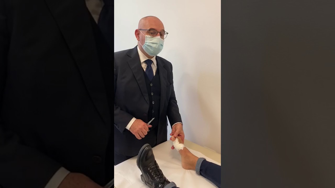 Alluce valgo in giovane paziente a 5 settimane dall’intervento