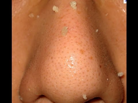 Get rid of blackheads and clogged pores WARNING GRAPHIC DAISERZ89